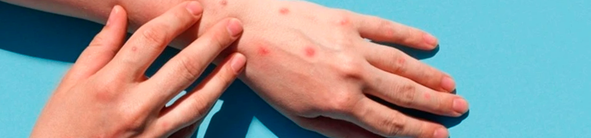 A imagem mostra uma mão com aparecem lesões avermelhadas na pele.